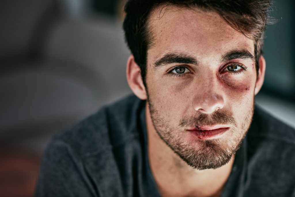 Cropped portrait of a beaten and bruised young man looking down.